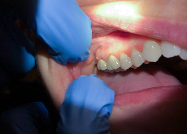 Best Emergency Denture Repair in Fort Lewis, WA